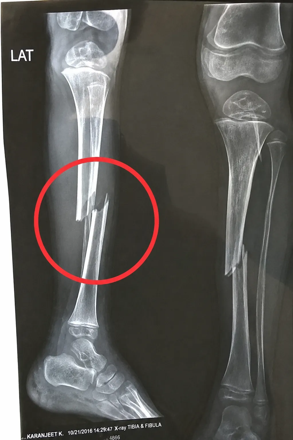 Emergency Surgery for Panidhra Reddy — photo 2